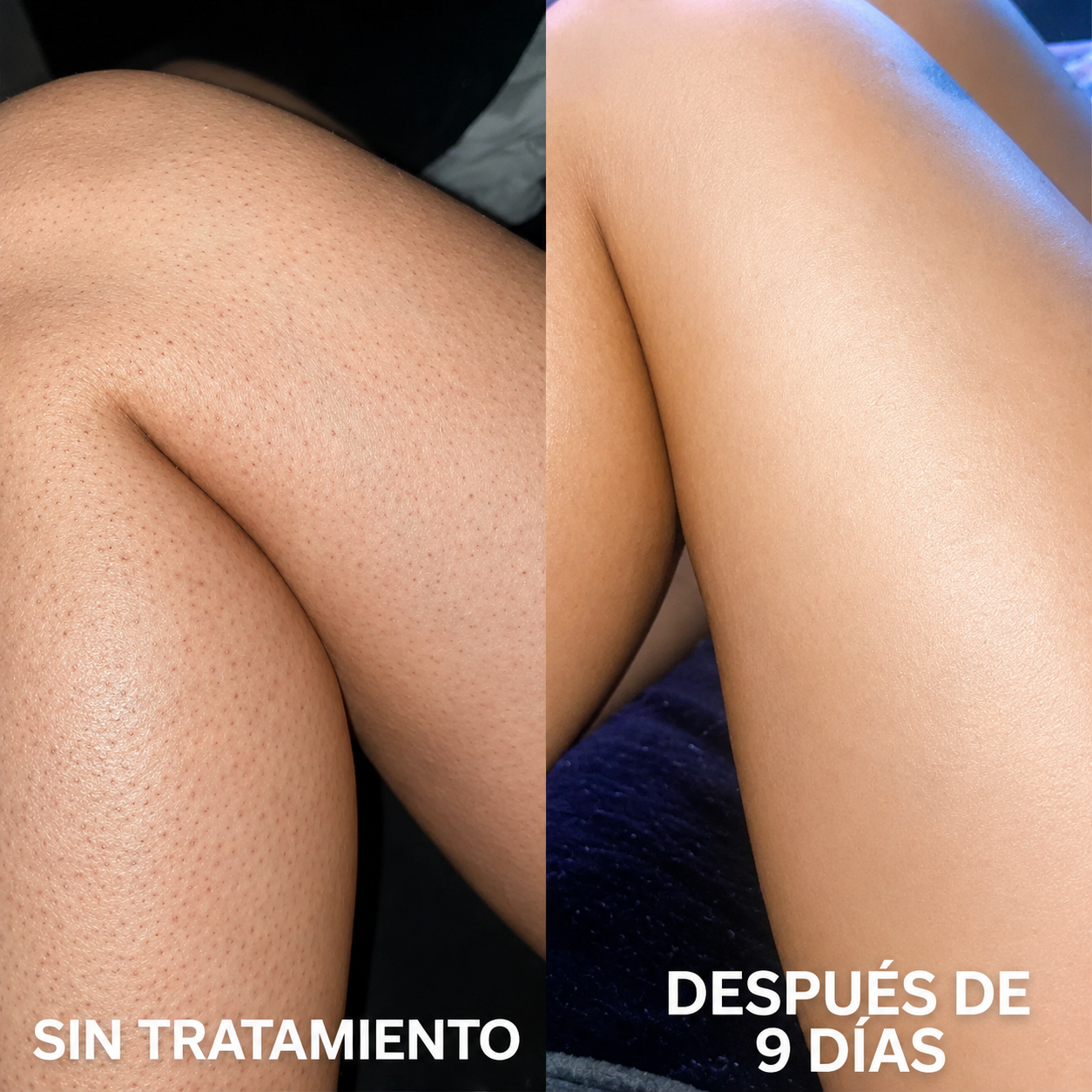 Crema Renovadora Corporal | Para piel de gallina y puntos rojos | Strawberry™