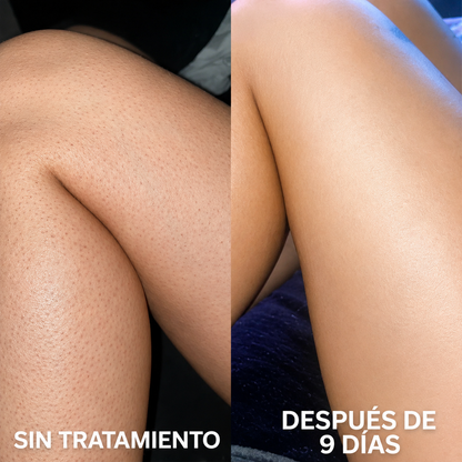 Crema Renovadora Corporal | Para piel de gallina y puntos rojos | Strawberry™