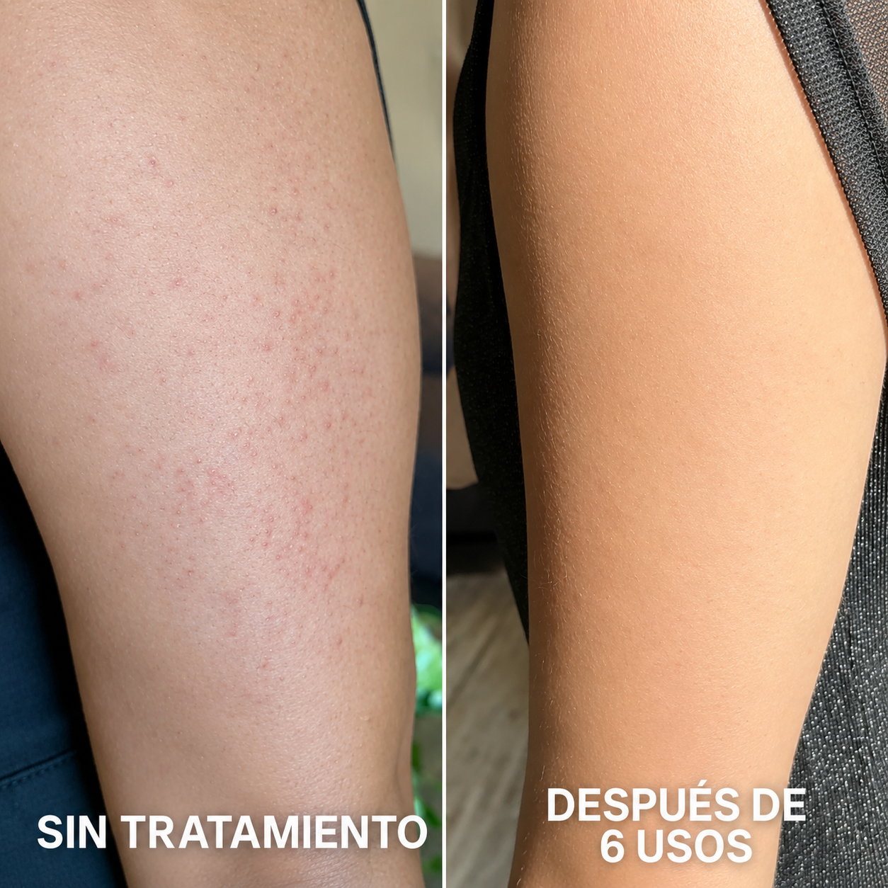 Crema Renovadora Corporal | Para piel de gallina y puntos rojos | Strawberry™